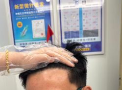 -大麦微针植发全国连锁