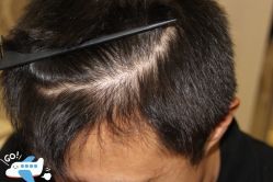 -大麦微针植发丨全国连锁