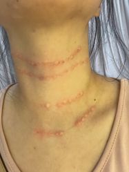 体验后-颜蕾医美黄金微针水光美肤玻尿酸抗衰中心