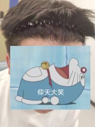 体验后-大麦微针植发全国连锁