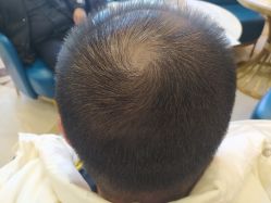 -碧莲盛·不剃发植发