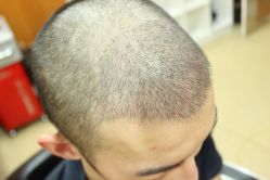 点击看大图 -大麦微针植发丨全国连锁