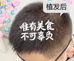 -大麦微针植发全国连锁