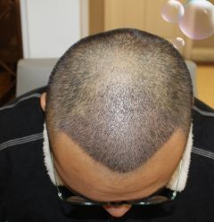 -大麦微针植发丨全国连锁