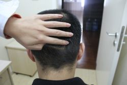 点击看大图 -大麦微针植发丨全国连锁