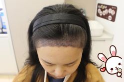 -大麦微针植发丨全国连锁