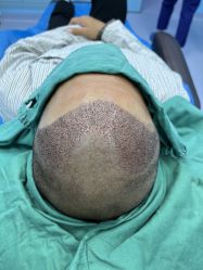 -大麦微针植发全国连锁