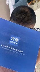 -大麦微针植发丨全国连锁
