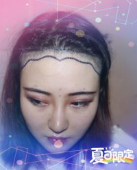 -大麦微针植发全国连锁