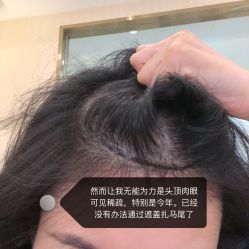 -碧莲盛·不剃发植发