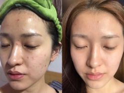 -苗方清颜痘肌研究所