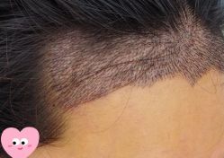 -大麦微针植发丨全国连锁