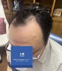 -大麦微针植发全国连锁