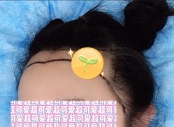 -大麦微针植发全国连锁