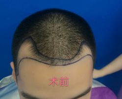 体验前-厦门美莱整形美容医院