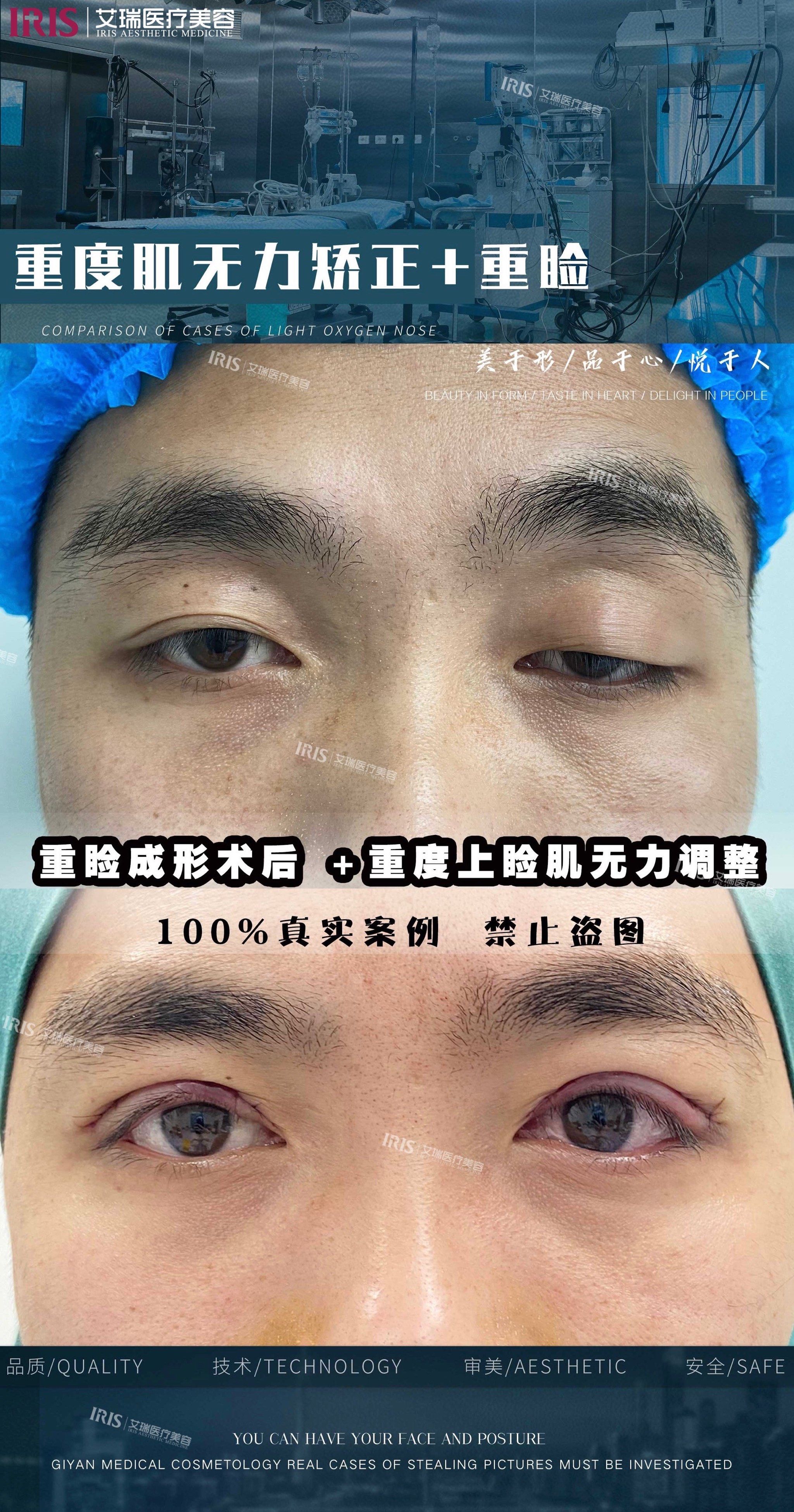 重度上睑肌无力调整 重睑成形术后🆚