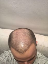 -大麦微针植发丨全国连锁