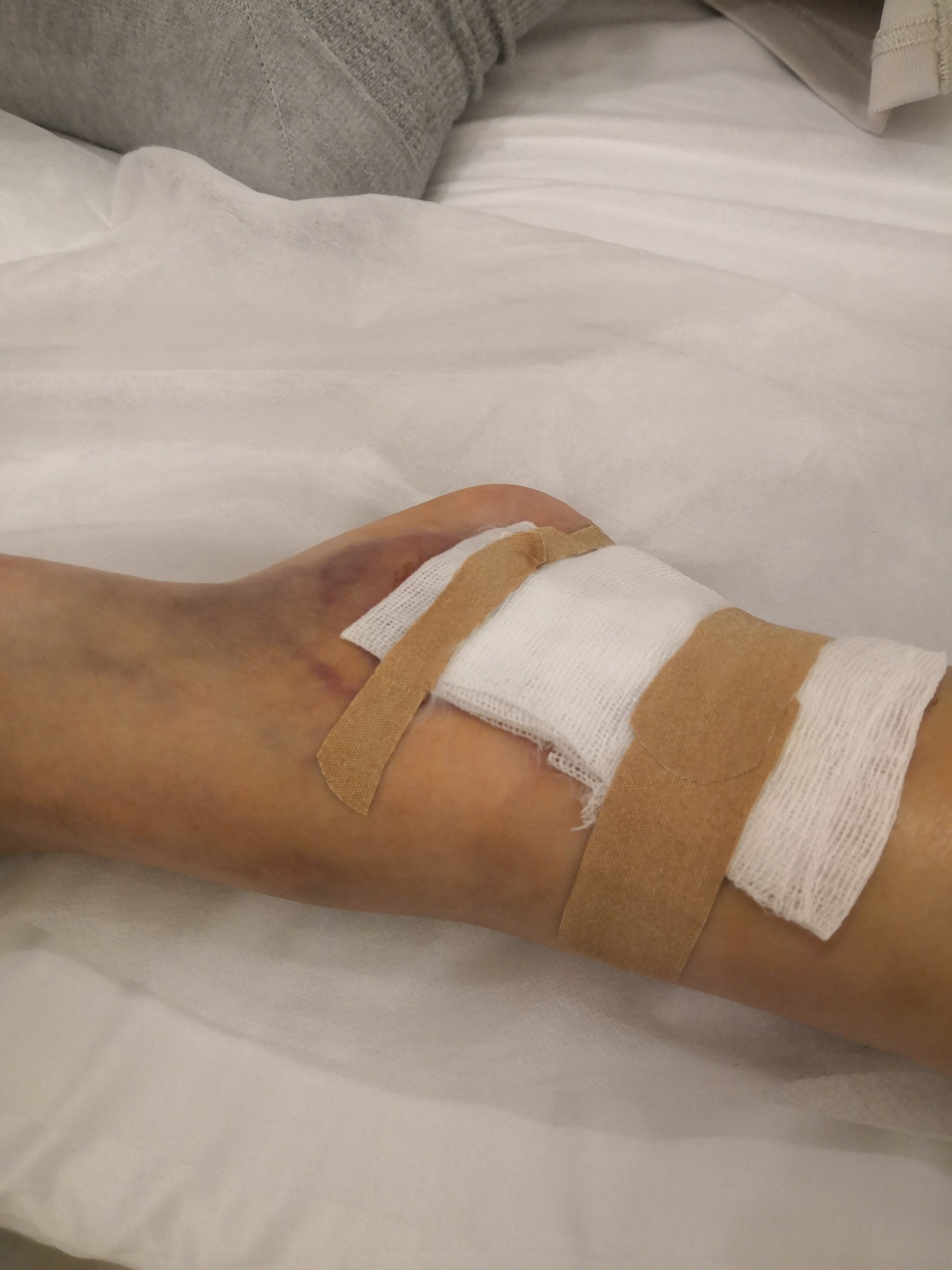 车祸后,受伤的脚该何去何从