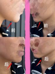 -小梨·OndaPro·专业脱毛连锁机构