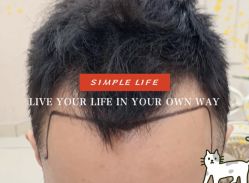 -大麦微针植发全国连锁