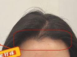 -大麦微针植发全国连锁