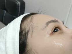 -KS科逆美肤祛痘
