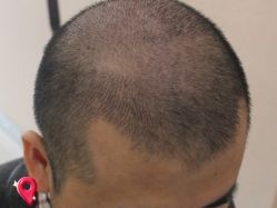 -大麦微针植发丨全国连锁