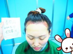 -大麦微针植发丨全国连锁