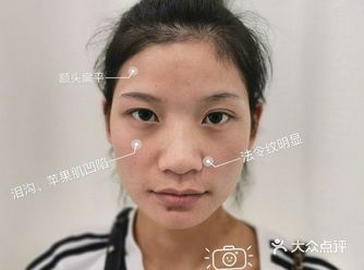 自体脂肪丰苹果肌效果能长久维持吗        