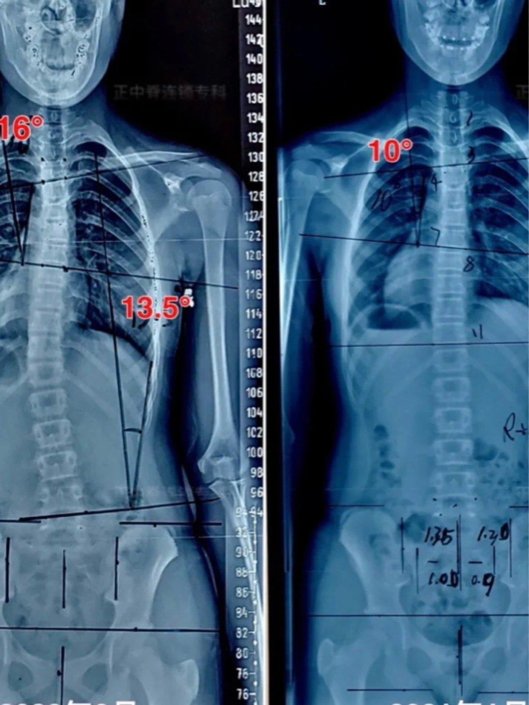 12岁女孩轻度脊柱侧弯,4个月康复训练记录