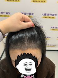 -大麦微针植发全国连锁