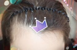 -大麦微针植发全国连锁