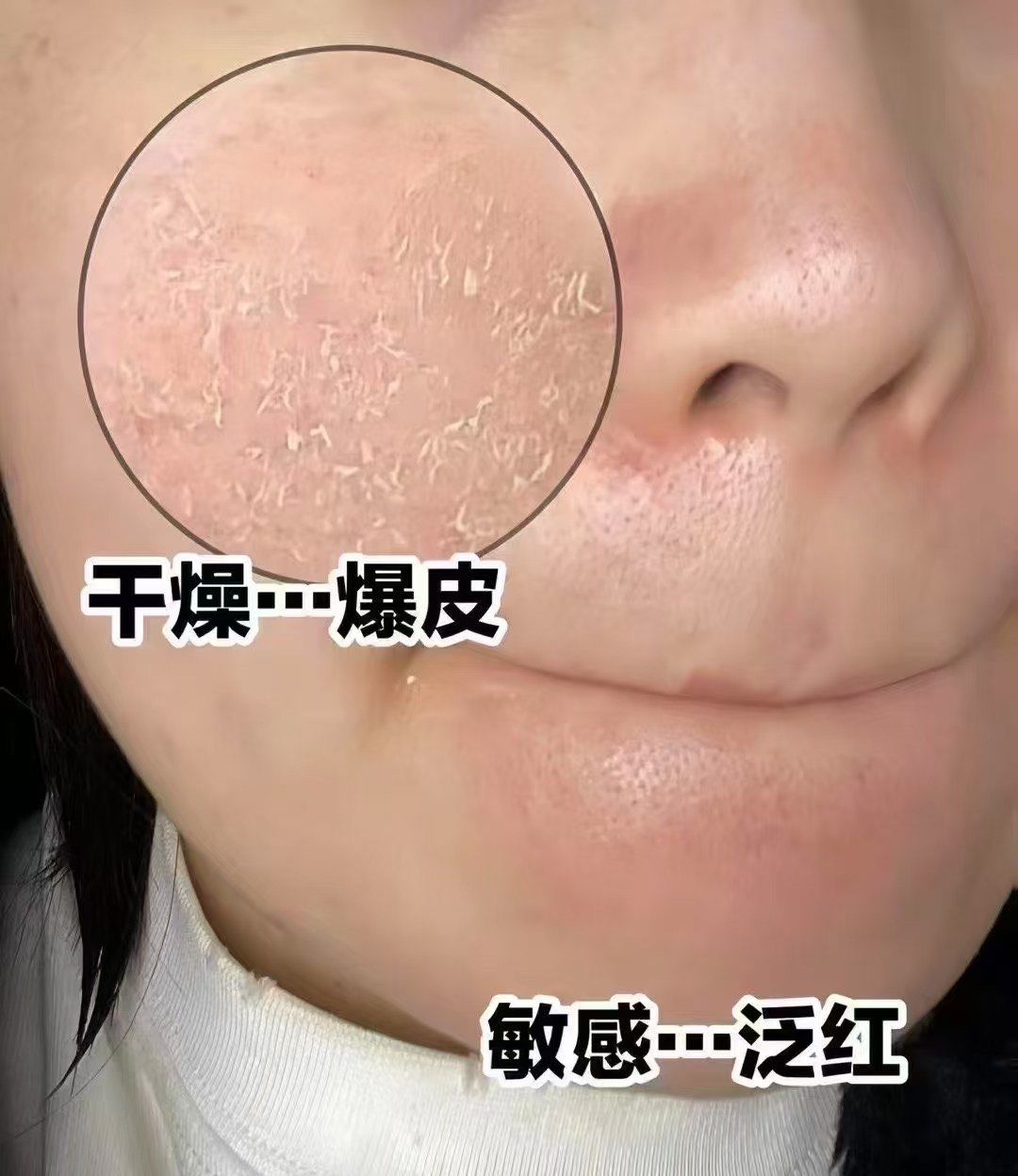 天气干燥,脸上太缺水,容易起皮脱屑,在家