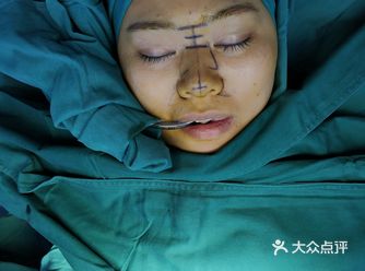 肋骨雕刻术,一个好看的鼻子关键是。。。。