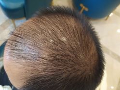 -碧莲盛·不剃发植发