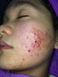 -蕾特恩专业祛痘