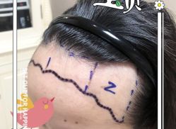 -大麦微针植发全国连锁