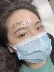体验后-郡艺医疗美容·微整·眼鼻吸脂