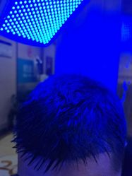 -碧莲盛·不剃发植发