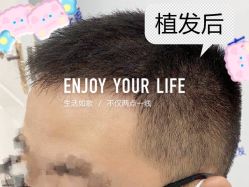 -大麦微针植发全国连锁