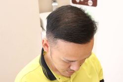 -大麦微针植发丨全国连锁