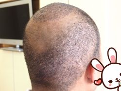 点击看大图 -大麦微针植发丨全国连锁