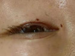 -痣清宫祛斑祛痣连锁店