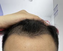 点击看大图 体验后-大麦微针植发丨全国连锁