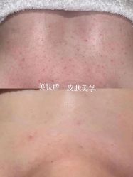 -美肤盾祛痘·问题肌头疗管理中心