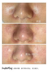 水氧+opt光疗-光SPA科技美肤