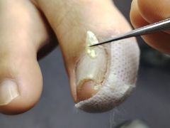 -祖传修脚甲沟炎灰指甲鸡眼