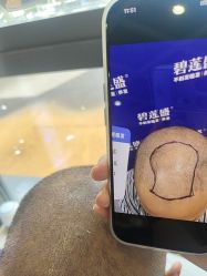 -碧莲盛·不剃发植发