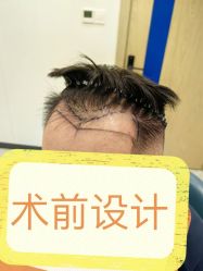 -大麦微针植发全国连锁