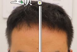 -大麦微针植发全国连锁